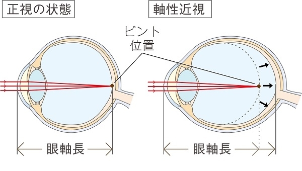 お子様の近視進行を抑制する目薬です